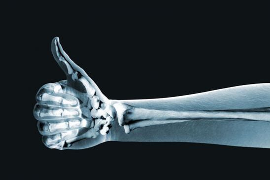 Röntgenaufnahmen können bei der Diagnose von Fingergelenkschmerzen helfen