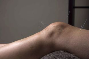 Akupunktur fördert die Reparatur von Gelenkgeweben