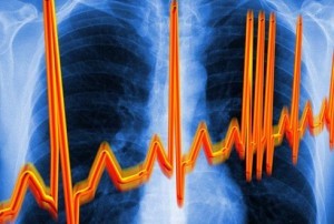 Veränderungen und Störungen im Herzrhythmus - ein Zeichen für zervikale Osteochondrose